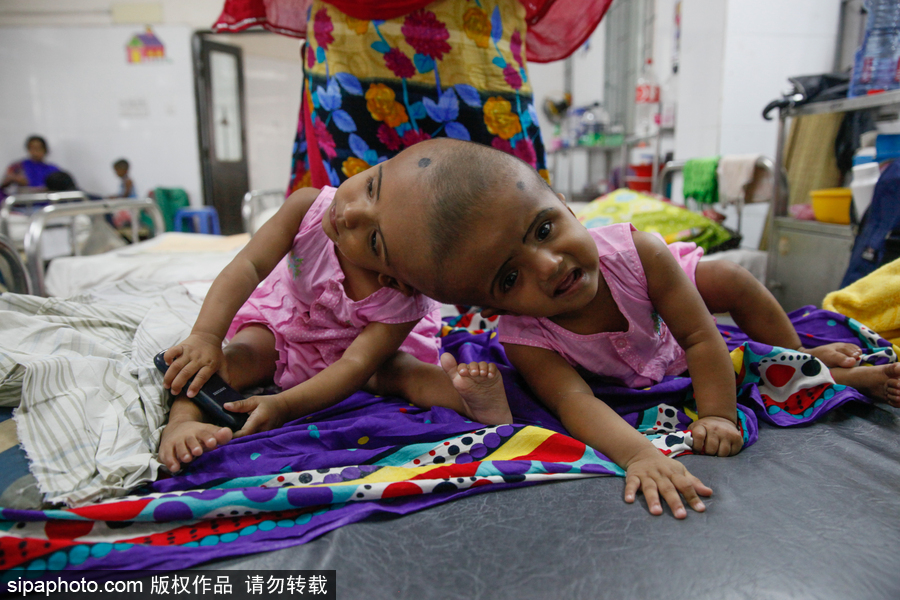 孟加拉國連頭嬰兒 至少到兩歲才能進行手術(shù)