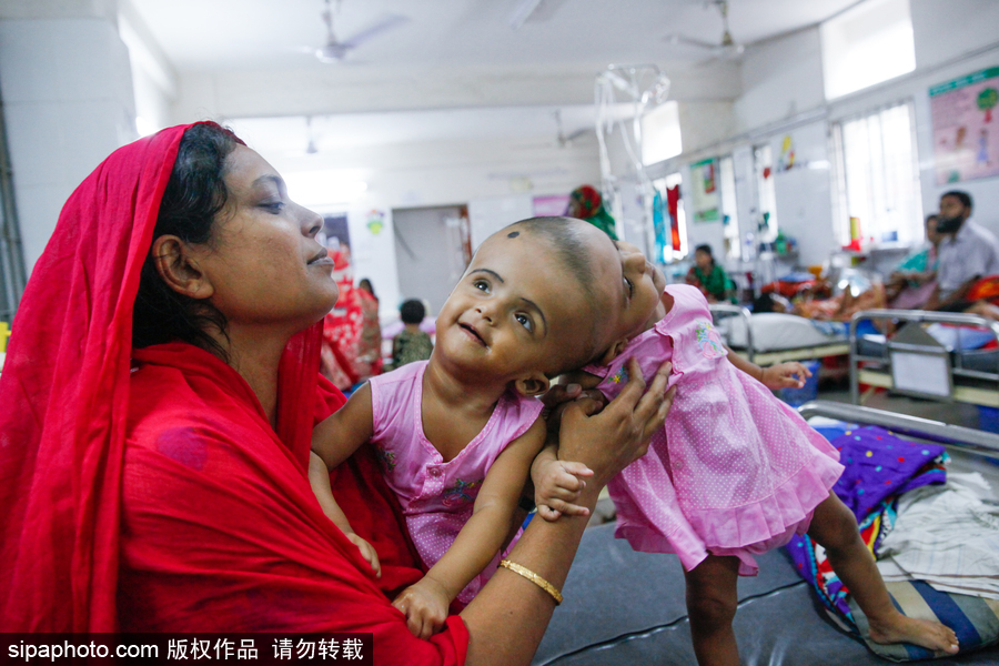 孟加拉國連頭嬰兒 至少到兩歲才能進行手術(shù)