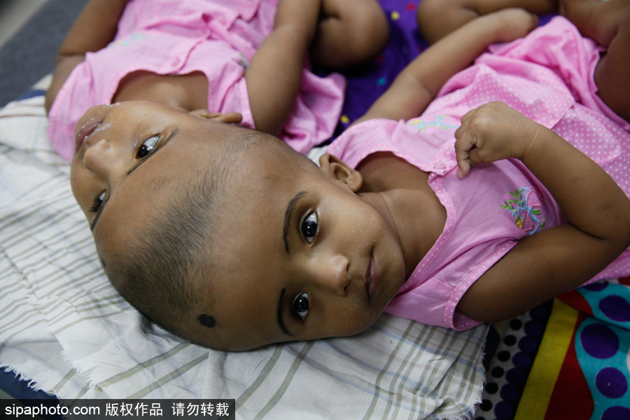 孟加拉國連頭嬰兒 至少到兩歲才能進行手術(shù)
